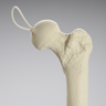 Knee Replacement with Tibia and Femur for #1301-169 and 1301-169-1