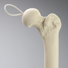 Knee Replacement with Tibia and Fibula