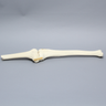 Knee with Plateau Fracture