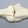 Knee with Plateau Fracture