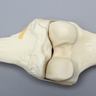 Knee with Plateau Fracture
