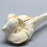 Knee with Plateau Fracture