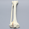 Tibia and Fibula with Condylar, Malleolar, and Oblique Fractures