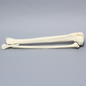 Tibia and Fibula with Condylar, Malleolar, and Oblique Fractures