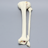 Tibia and Fibula with Condylar, Malleolar, and Oblique Fractures