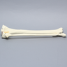 Tibia and Fibula with Condylar, Malleolar, and Oblique Fractures