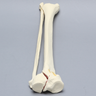 Tibia and Fibula with Bicondylar "Y" Fracture
