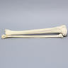 Tibia and Fibula with Bicondylar "Y" Fracture