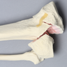 Tibia and Fibula with Bicondylar "Y" Fracture