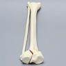 Tibia and Fibula with Bicondylar "Y" Fracture