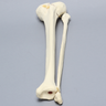 Tibia and Fibula with Bicondylar "Y" Fracture