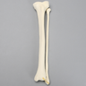 Tibia and Fibula with Oblique Fibular Fracture