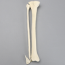 Tibia and Fibula with Oblique Fibular Fracture