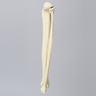 Tibia and Fibula with Blount's Disease