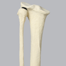 Tibia and Fibula with Blount's Disease