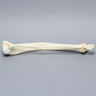 Tibia and Fibula with 30 Degree Valgus Fracture