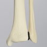 Tibia and Fibula with Fibular Rotation