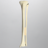 Tibia and Fibula with Fibular Rotation