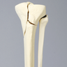 Tibia and Fibula with Plateau and Oblique Fractures
