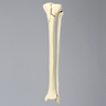 Tibia and Fibula with Plateau and Oblique Fractures