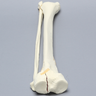 Tibia and Fibula with Type Six Tibial Plateau Fracture