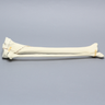 Tibia and Fibula with Type Six Tibial Plateau Fracture