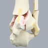 Tibia and Fibula with Pilon and Fractures
