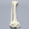 Tibia and Fibula with Butterfly Fracture