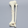 Tibia and Fibula with Butterfly Fracture