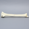 Tibia and Fibula with Butterfly Fracture