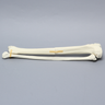 Tibia and Fibula with Butterfly Fracture