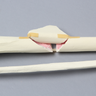Tibia and Fibula with Butterfly Fracture