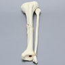 Tibia and Fibula with Butterfly Fracture