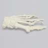 Forefoot with Hammertoes, Bunions, and Exostosis, Left