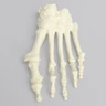 Forefoot with Hammertoes, Bunions, and Exostosis, Left