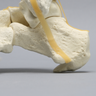 Foot and Ankle with Hammertoes, Bunions, and Heel Spur