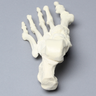 Foot with Hammertoes, Bunions, and Heel Spur