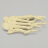Forefoot with Hammertoes, Bunions, and Exostosis, Right