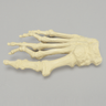 Forefoot with Hammertoes, Bunions, and Exostosis, Right