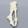 Metatarsals with Hammertoe and Bunion