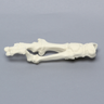 Metatarsals with Hammertoe and Bunion