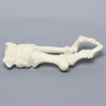 Metatarsals with Hammertoe and Bunion