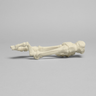 Metatarsals with Hammertoe and Bunion