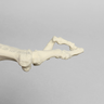 Metatarsals with Hammertoe and Bunion