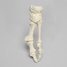 Metatarsals with Hammertoe and Bunion