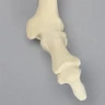 Metatarsal with Hammertoe