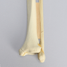 Ankle with Malleolar, Posterior, and Transverse Fractures