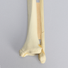 Ankle with Malleolar, Posterior, and Transverse Fractures