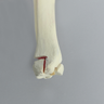 Ankle with Two-Part Triplane Fracture, Pediatric