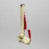 Ankle Joint with Ruptured Achilles
